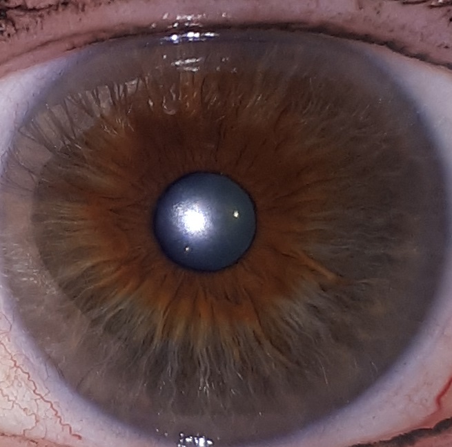 Comprendre l'iridologie, partie 4 les yeux mixtes Supernaturo Comprendre l'iridologie, partie 4 les yeux mixtes Supernaturo