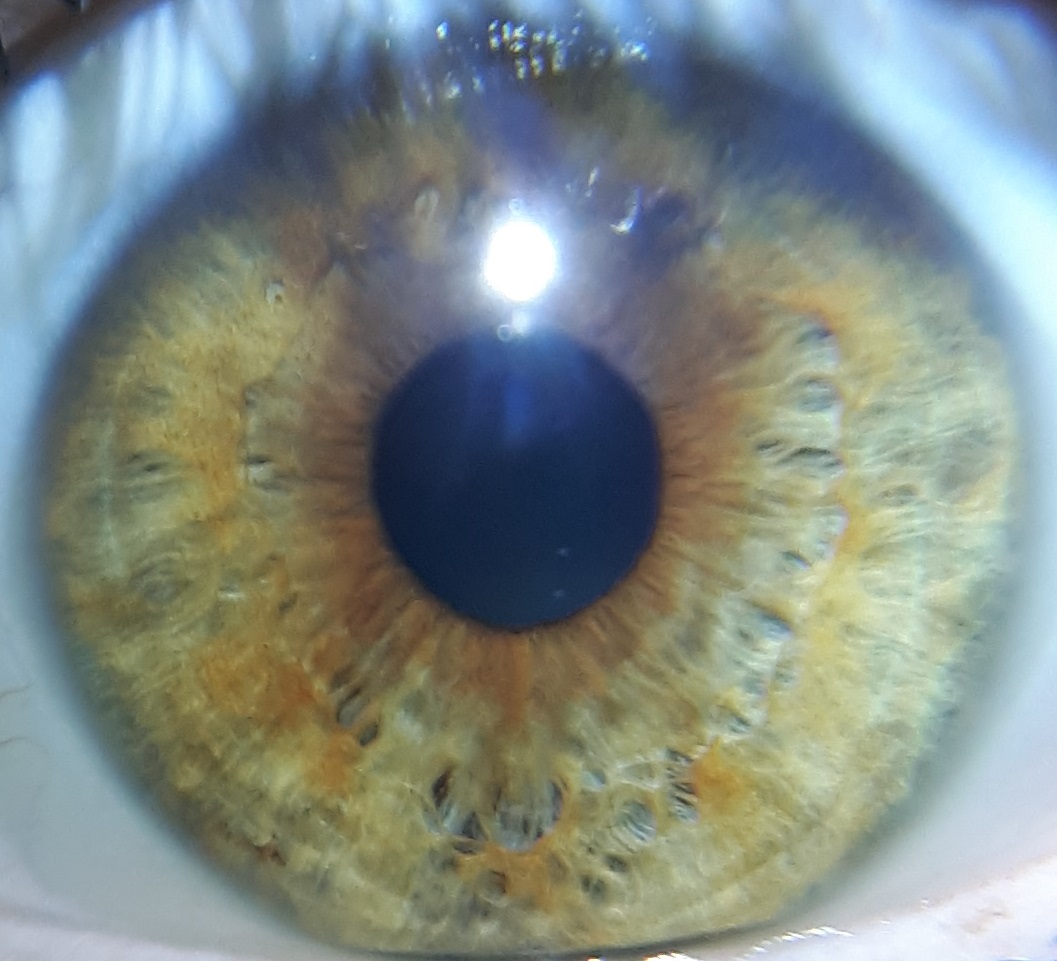 Lire la suite à propos de l’article Comprendre l’iridologie, partie 4 : les yeux mixtes